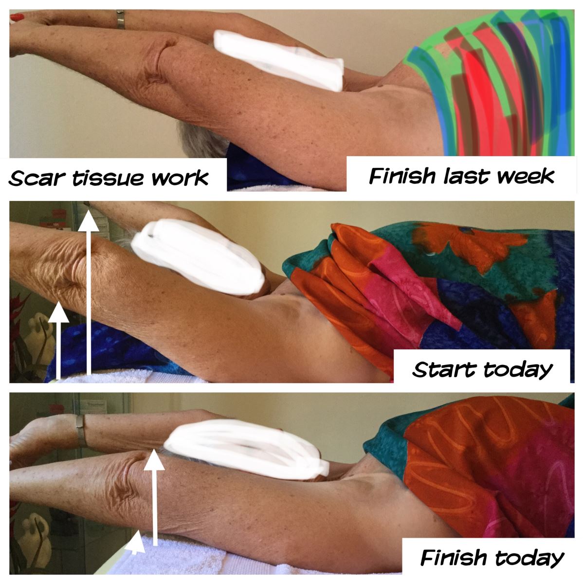 Scar Tissue Release Therapy
